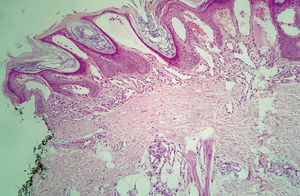 Overall appearance on histopathology. Mild hyperkeratosis and acanthosis; papillomatosis; vascular proliferation, predominantly in the papillary dermis (Hematoxylin & eosin, x50)