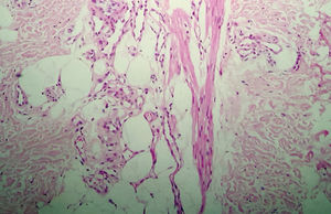 Fundamental detail on histopathology. Proliferation of small vessels also in the subcutaneous tissue, characteristic of verrucous hemangioma (Hematoxylin & eosin, x200)