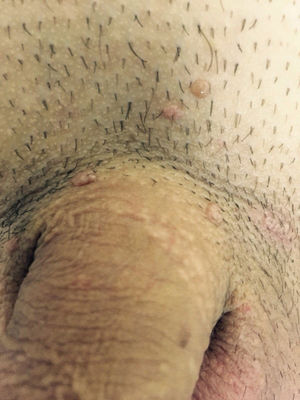 Brown verrucous papules on the penis