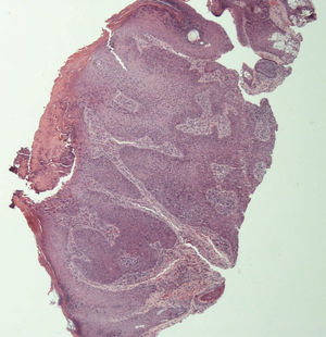 Bowenoid squamous cell carcinoma (Hematoxylin & eosin, x40)