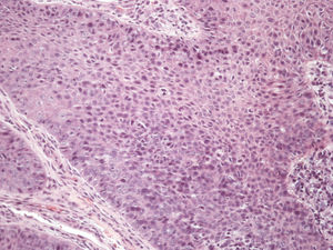 Bowenoid squamous cell carcinoma (Hematoxylin & eosin, x100)