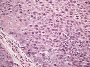 Bowenoid squamous cell carcinoma (Hematoxylin & eosin, x200)