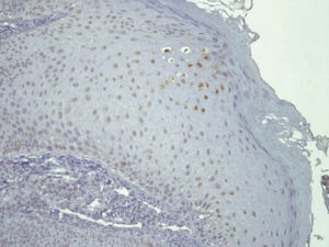 Positive in situ hybridization for high-risk HPV