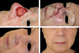 A - Surgical defect. Flap design (dotted line). The arrow indicates the flap movement, B - Immediate postoperative C - Lateral view, result at 18 months, D - Frontal view with camouflaged incisions