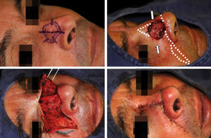 A - Invasive squamous cell carcinoma marked for Mohs’ surgery. B - Resulting defect with the flap design (dotted line). Arrows indicate bilateral advancement to be performed C - Flap elevated, D - Immediate postoperative