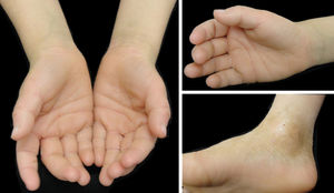 Patient presenting fine scales throughout body surface (A, B)
