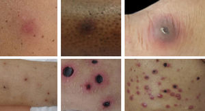 A - Erythematous nodule on the right arm; B - brownish nodule with erythematous halo on the left leg; C - violaceous nodule with necrotic center in the right metatarsophalangeal region; D - erythematous and ulcerated nodules on the legs; E and F - diffuse violaceous nodules, with ulcerated centers and crusted necrotic covering, on the face, trunk and upper and lower limbs