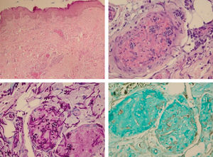 A - Presence of proliferating capillary vessels, with ectasiated lumen filled with fibrin thrombi, in the superficial and deep layers of the dermis (Hematoxylin & eosin, x40); B - in detail, one of the intravascular fibrin thrombi containing numerous hyphae and spores within (Hematoxylin & eosin, x400); C and D - using PAS (C) and Grocott (D) stains, the presence of hyphae and spores in the thrombi is most evident (x400)