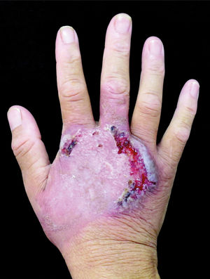 Dorsum of the right hand. Erythematoviolaceous annular plaque with exulcerated border