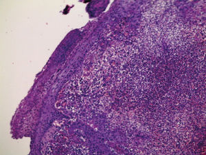 Skin with solid and diffuse inflammatory infiltrate in the dermis (Hematoxylin & eosin, x40)