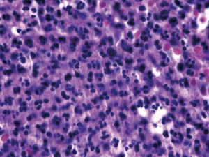 The infiltrate is predominantly composed of neutrophils, some with leukocytoclasia (Hematoxylin & eosin, x400)