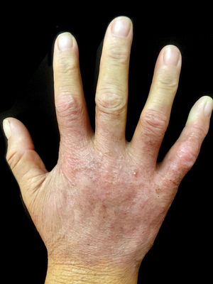 Dorsum of the right hand. Nearly complete regression. Residual erythema