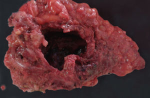 The excised cystic tumor mass