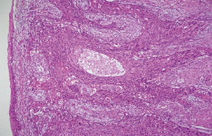 Tumoral mass lined by squamous epithelium with intensive dysplasia and contained tumoral invasion. Atypical cells with keratinization in solid masses and cordons. (Hematoxylin & eosin, x40).