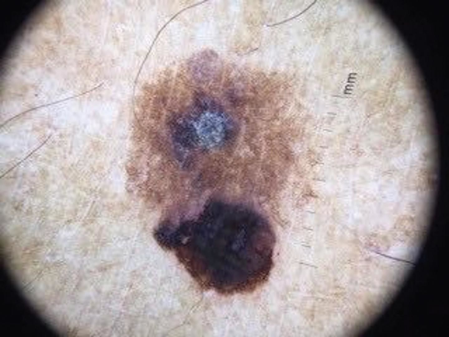 Collision tumor: pigmented Bowen’s disease and seborrheic keratosis ...