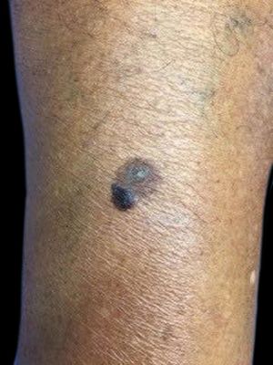 A brownish plaque on the lateral face of the right leg, suggestive of seborrheic keratosis, and a blackened, papular lesion with irregular borders at the edge of the plaque, suggestive of melanoacanthoma or melanoma