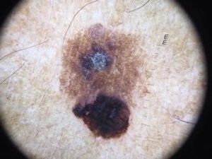 Dermatoscopy of the plaque lesion: cerebriform pattern in the upper region of the lesion, central crust, and fingerprint pattern on the border—findings compatible with seborrheic keratosis