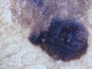 Dermatoscopy of the papular lesion at higher magnification, showing a melanoma-like lesion with blackened blotch, pigment network in the lower region, rosette, pseudopod and bluish-gray veil