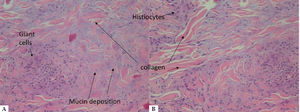 Light microscopy. A - basophilic mucin deposition, histiocytes and multinucleated giant cells (Hematoxylin & eosin, x200). B - disorganized collagen bundles (Hematoxylin & eosin, x200)