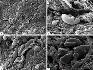 Scanning electron microscopy. A - Strong compaction of dermal collagen. (x1,500); B - isolated histiocyte with a lymphocyte to the left (x7,000); C - detail of an area with significant compaction of collagen, with palisading histiocytes (x5,000); D - grouped histiocytes (x6,000)