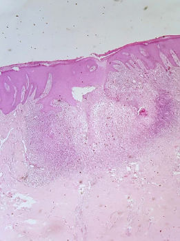Suppurative granulomatous nodular process associated to cicatricial fibrosis (Hematoxylin & eosin, x100)