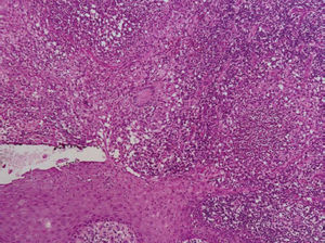 Epithelioid granuloma with suppurative center (Hematoxylin & eosin, x200)