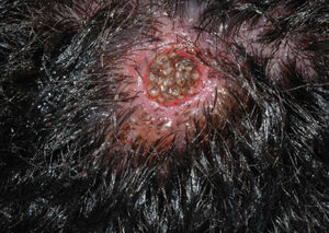 Well-circumscribed round ulcer with multiple larvae