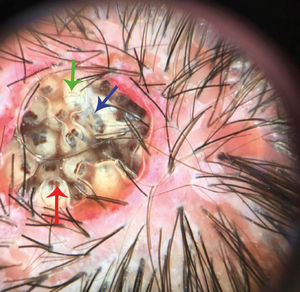Numerous yellowish-white larvae, with multiple brown dotted rings (green arrow), tracheal tube (blue arrow) and respiratory spiracle (red arrow). Erythema and perifollicular scaling on the scalp can be seen in the periphery