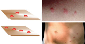 A - Scheme showing variations in the “breakfast, lunch, and dinner” pattern suggestive of infestation with fleas or bedbugs; B - papules caused by dog flea bites (Ctenocephalides canis); C - bedbug bites (Cimex lectularius) Images: Gabriel Peres, Vidal Haddad Júnior, and João Luiz Costa Cardoso.