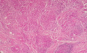 Histopathological exam showing epithelioid cell granulomas without lymphocyte border (“naked granuloma”), surrounded by fibroplasia (Hematoxylin & eosin, x100)