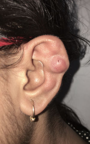 Reddish-yellow nodule with telangiectasia present on the pinna of the left ear