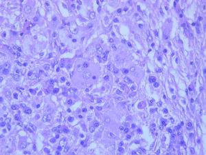 Dermal infiltrate composed of histiocytes, giant cells and numerous plasma cells. Emperipolesis of lymphocytes and plasma cells within histiocytes (Hematoxylin & eosin, x400)
