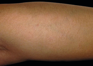 Small skin-colored papules, some of them translucent, symmetrically located on the dorsum of both forearms