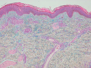Epidermis shows no alterations. Note the focal area in the upper and mid reticular dermis due to a separation of collagen fibers. The area is positively stained with alcian blue, indicating deposit of mucin (Alcian blue, x40)