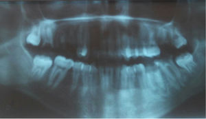 Panoramic radiograph of the dental arch