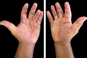 Presence of skin retraction on the left fourth finger