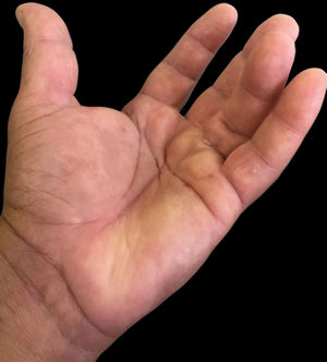 Nodule in the metacarpophalangeal region of the left fourth finger, covered by healthy skin