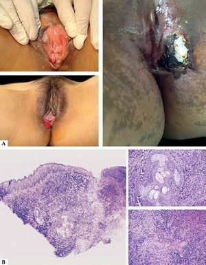 A-Multiple Lipschutz ulcers, on both labia, as kissing ulcers, sometimes can be very large. B - Histological aspect showing dense predominantly perivascular lymphocytic infiltrate, also affecting the wall of blood vessels and sebaceous glands (Hematoxylin and eosin, x2 and x40)