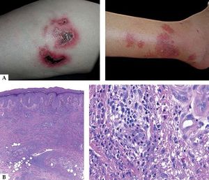 A-Abnormal reaction to mosquito bite. They are infiltrated, painful lesions, and some ulcerated. B - Histological aspect of the insect bite site showing a dense mixed infiltrate, with presence of eosinophils and atypical lymphoid cells (Hematoxylin and eosin, x2 and x40)