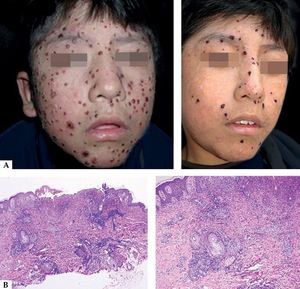 A-Clinical aspect of hydroa vacciniforme, with ulcerated lesions leaving depressed scars. In chronic forms, recurrences can occur. B - Histopathology of an acute lesion showing ulceration and a mixed type infiltrate, granulation tissue and infiltrate of large lymphocytes with epithelial and adnexal tropism (Hematoxylin and eosin, x2 and x40)