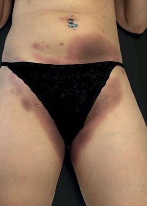Sharply demarcated erythematous/violaceous plaques on abdomen and groin