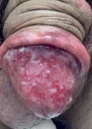 Before treatment. Bright, moist, poorly delimitated erythematous plaque located on the glans penis and foreskin