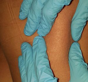 Multiple erythematous, infiltrated plaques, with diffuse borders, irregular size and shape, with increase of the local temperature, extended on both gluteus, thighs and legs
