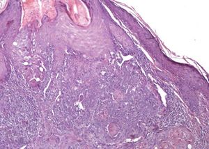 Central area with neoplastic proliferation associated with hair follicles. Periphery with solar elastosis and vascular ectasias (Hematoxylin & eosin, x100)