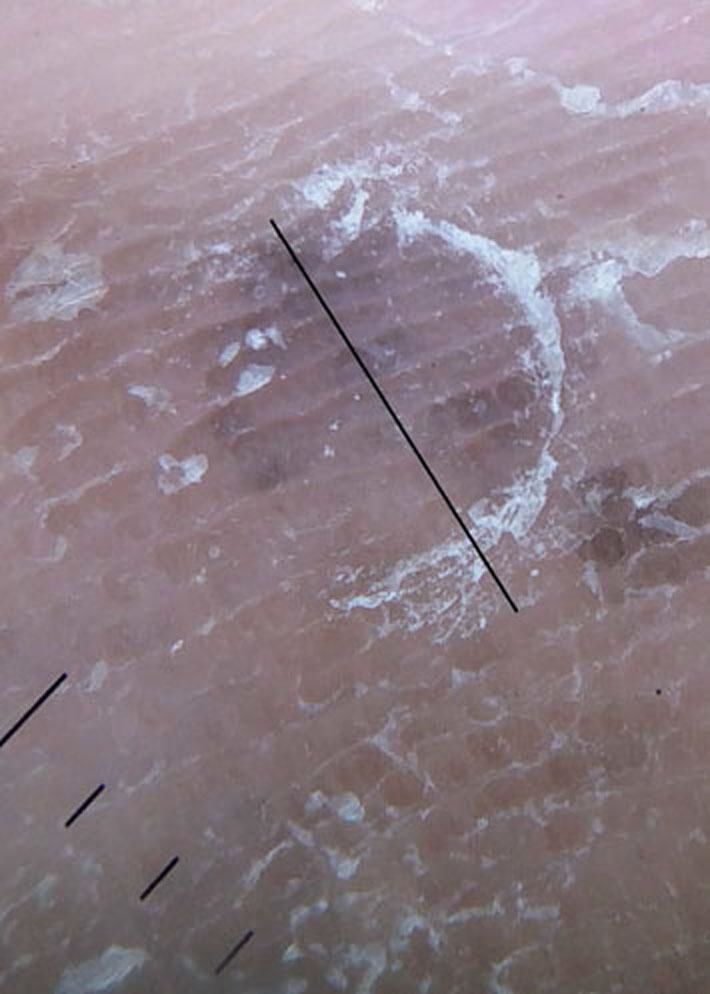 Vertical plane ex vivo dermoscopy: a novel dermoscopic technique. A ...