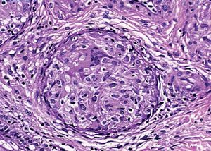 Paracoccidioidomycosis: well-formed epithelioid granuloma with giant cell and no visible fungus. Hematoxylin & eosin, x100