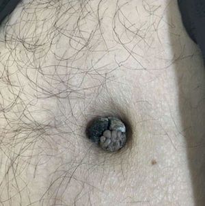 Brownish cerebriform umbilical nodule 2cm in diameter with surrounding serous and hematic crust