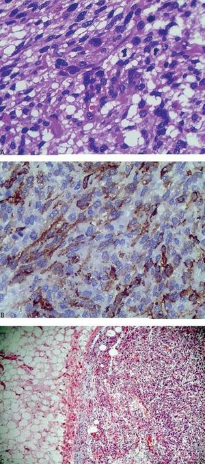 A - Hematoxylin & eosin; original magnification, x40. Subcutaneous PEComa; B - Immunohistochemistry; original magnification, x40. Reaction of tumor cells to SMA marker. C - Hematoxylin & eosin; lower magnification, 4x