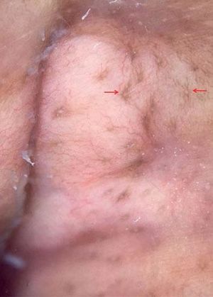 Dermoscopy examination of a nodular lesion revealed pigmented stripes radiated from hair follicles (indicated by red arrows) on a pink background, as well as linear branched and reticular vascular patterns