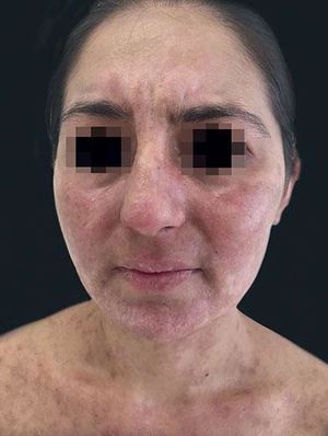 Improvement of facial lesions after treatment and hospital discharge